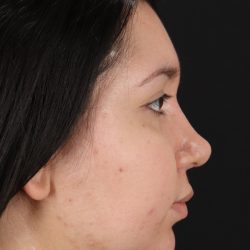 Chin Implant Before & After Patient #1604