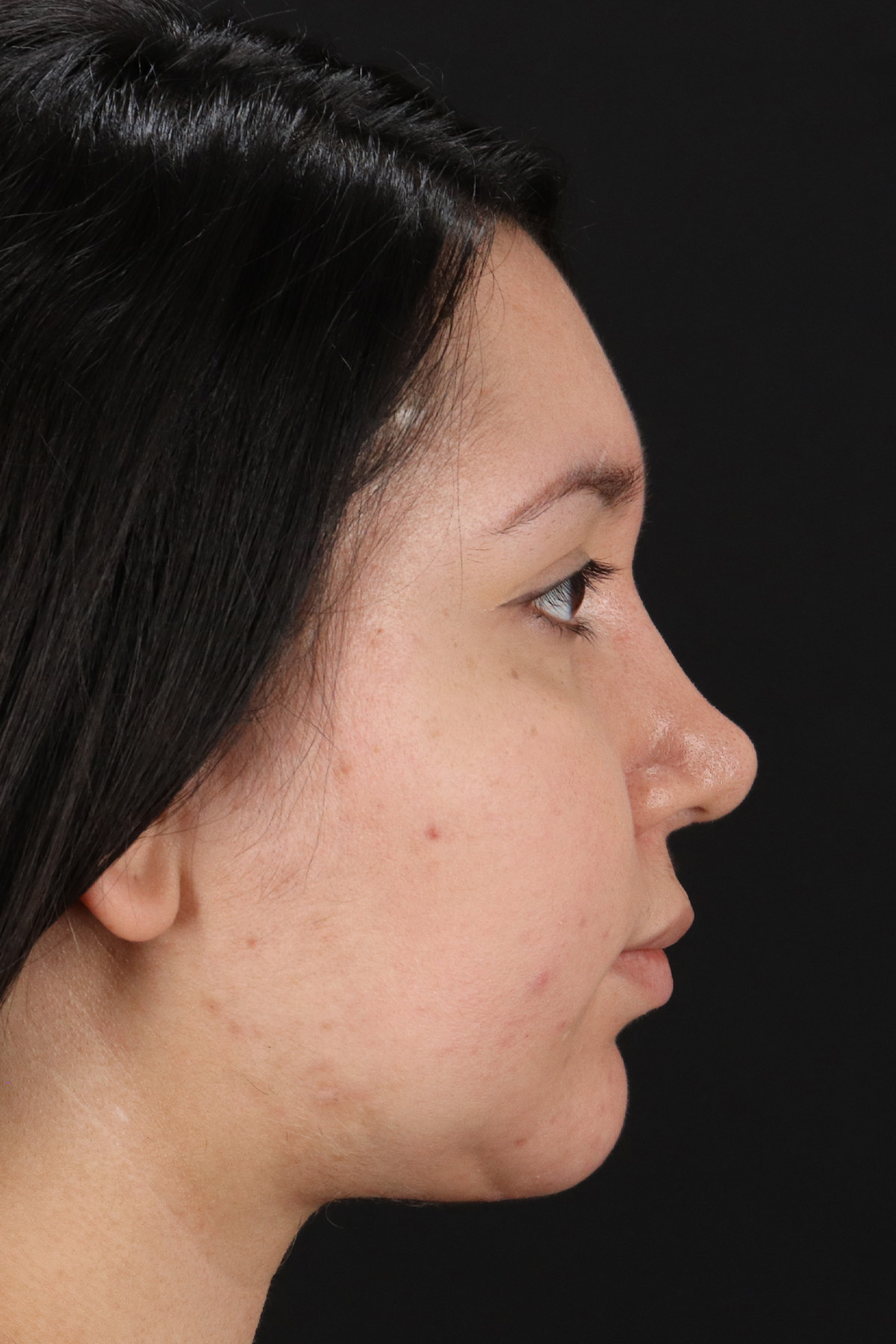 Chin Implant Before & After Patient #1604