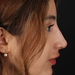 Liquid Rhinoplasty Before & After Patient #2254