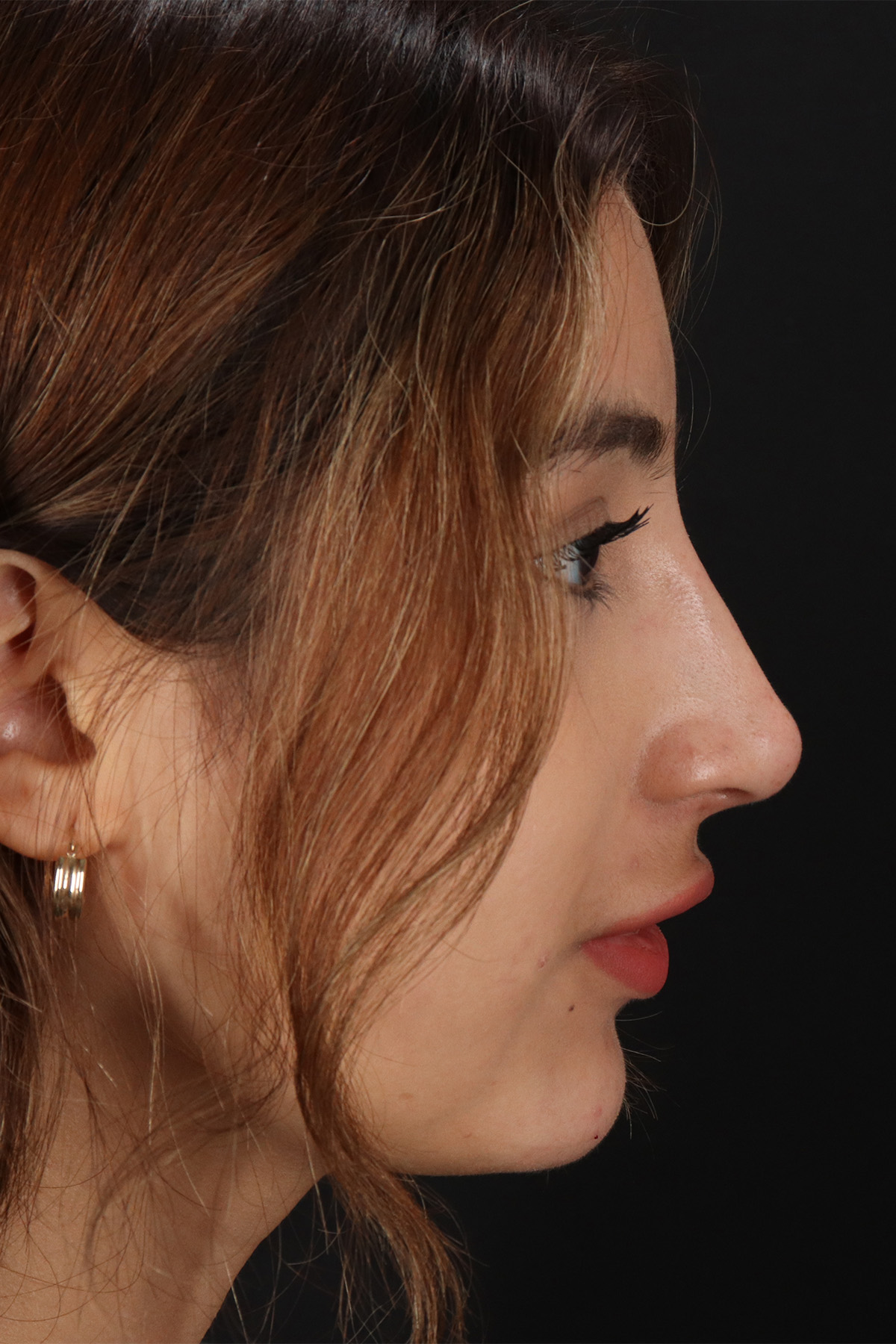 Liquid Rhinoplasty Before & After Patient #2254
