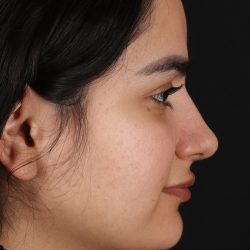 Rhinoplasty Before & After Patient #3071