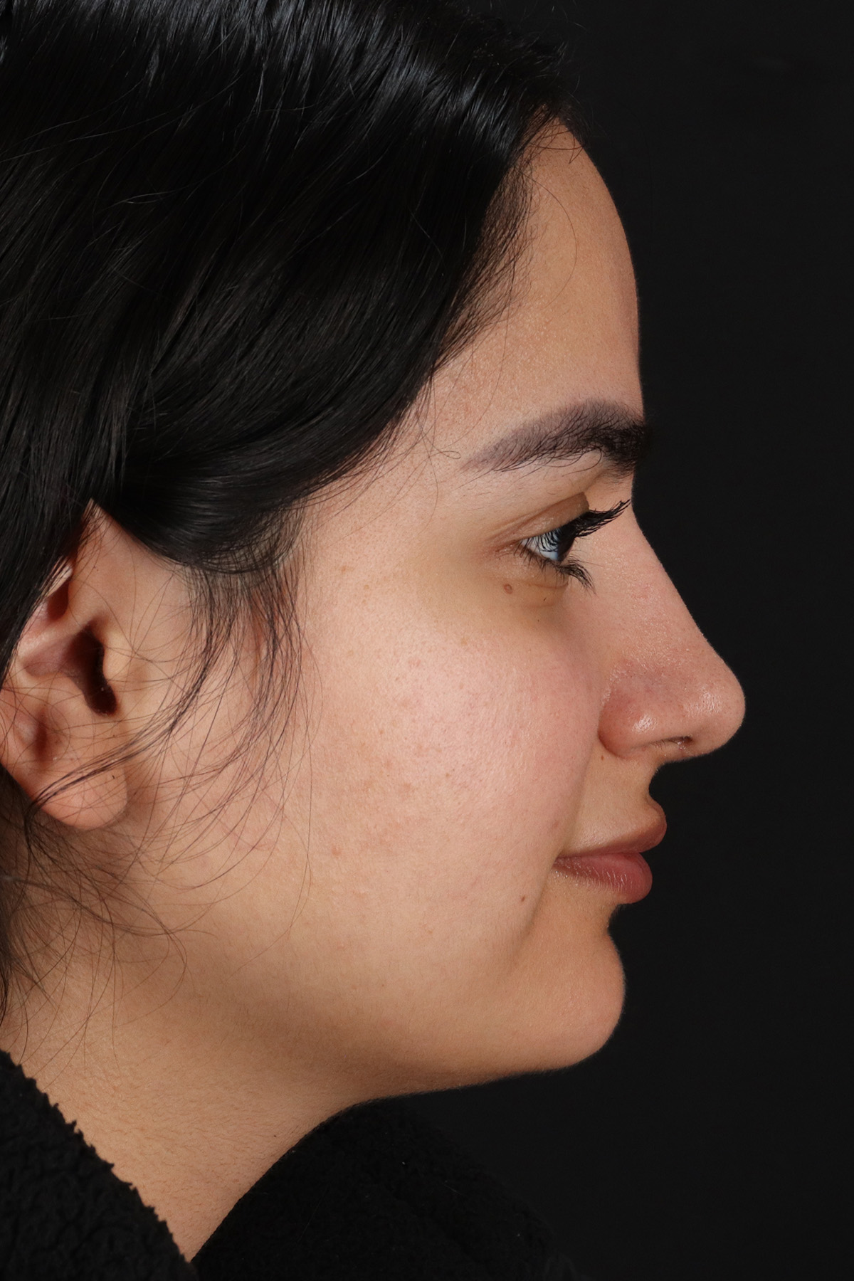 Rhinoplasty Before & After Patient #3071