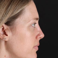 Rhinoplasty Before & After Patient #3291