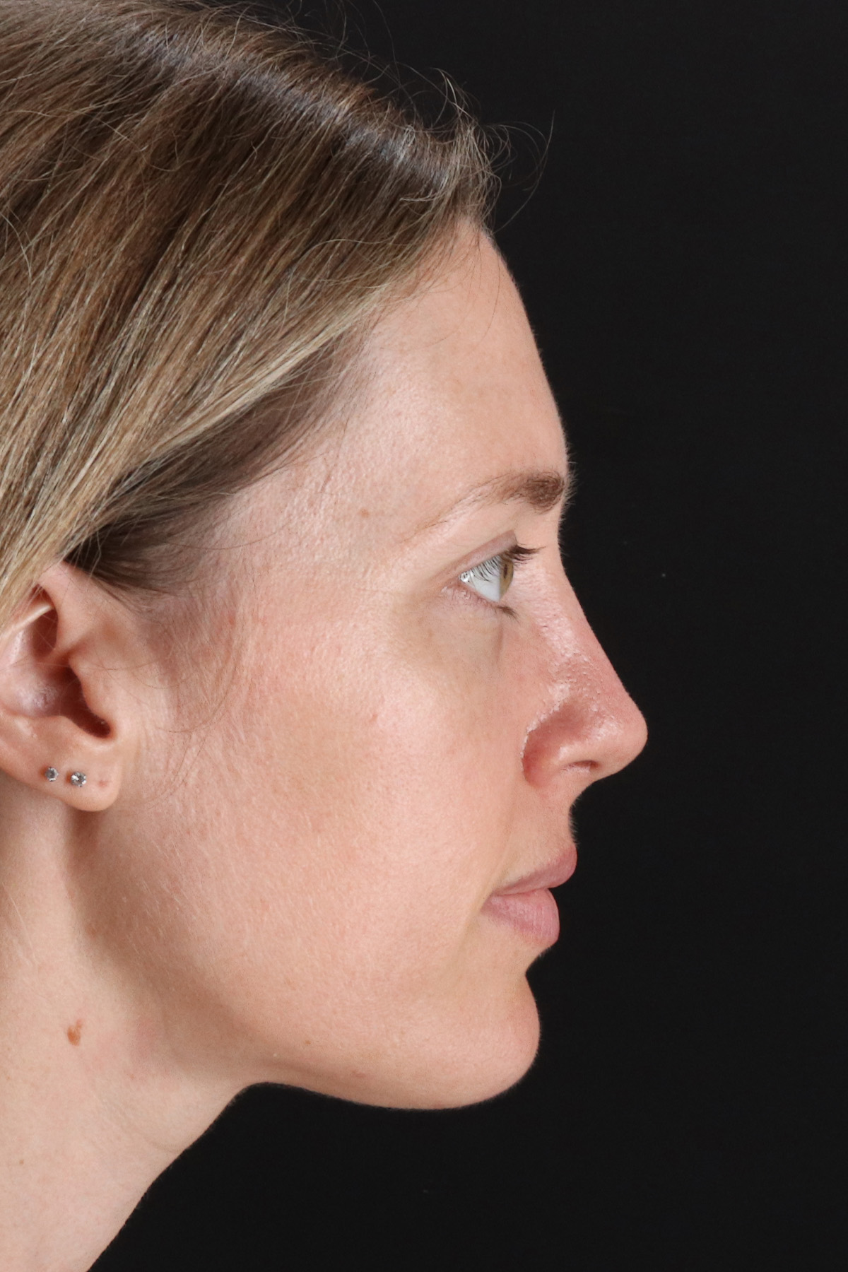 Rhinoplasty Before & After Patient #3291