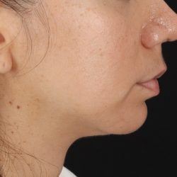 Chin Implant Before & After Patient #1540