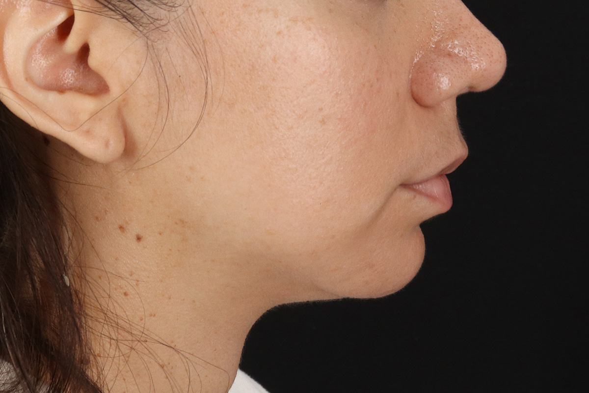 Chin Implant Before & After Patient #1540
