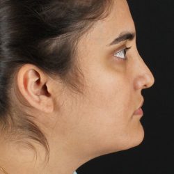 Neck Lift Before & After Patient #2560