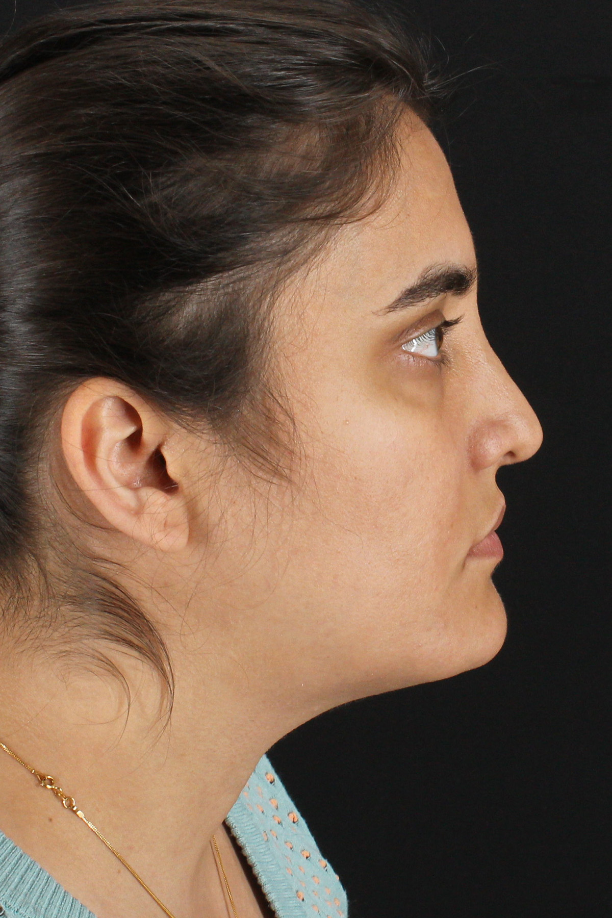 Neck Lift Before & After Patient #2560