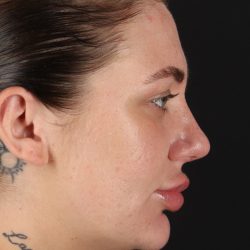 Rhinoplasty Before & After Patient #3104