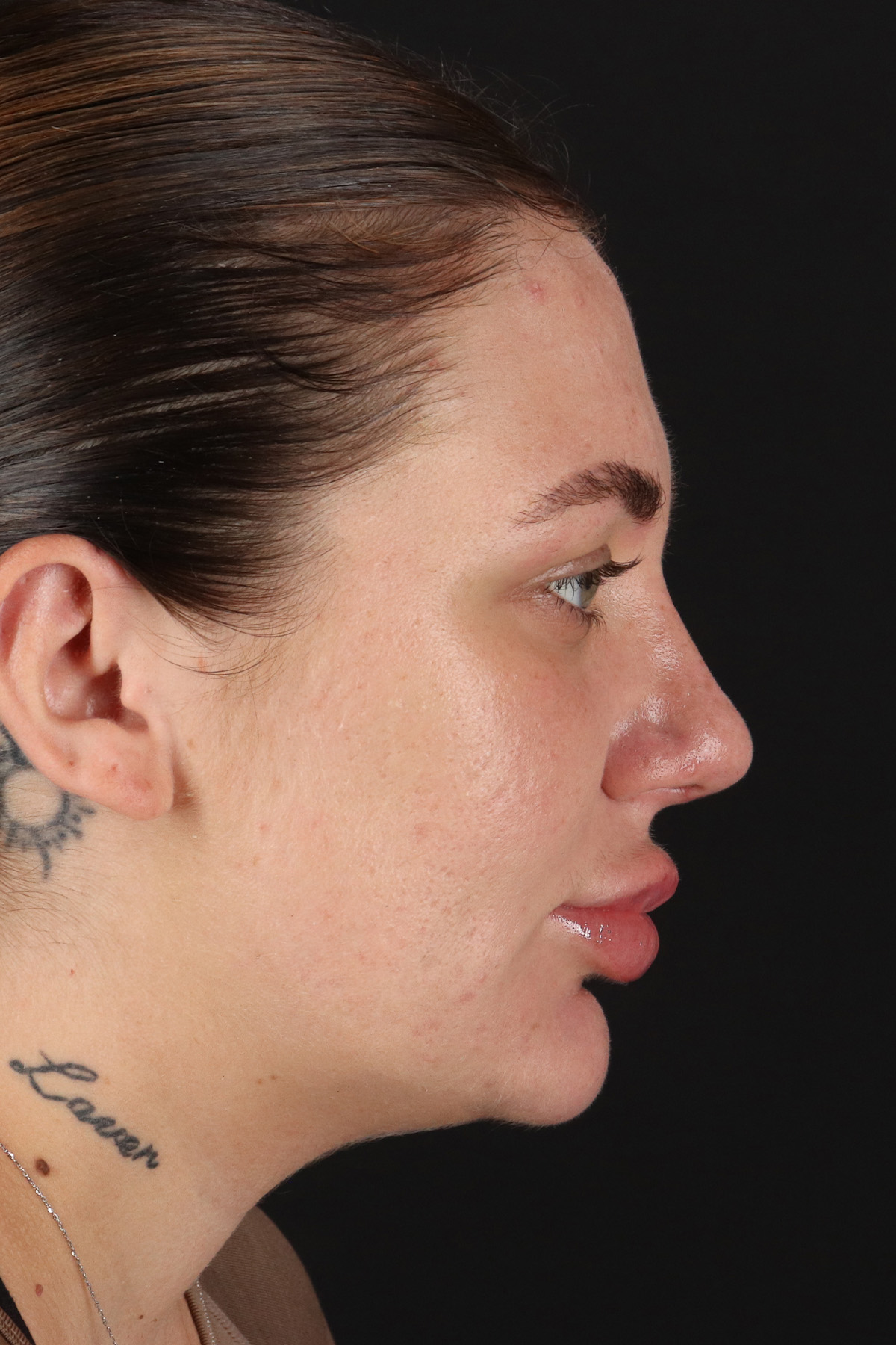Rhinoplasty Before & After Patient #3104
