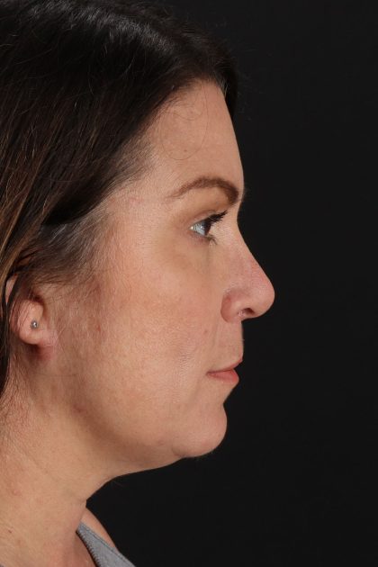 Lip Lift Before & After Patient #2133
