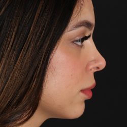 Rhinoplasty Before & After Patient #3269