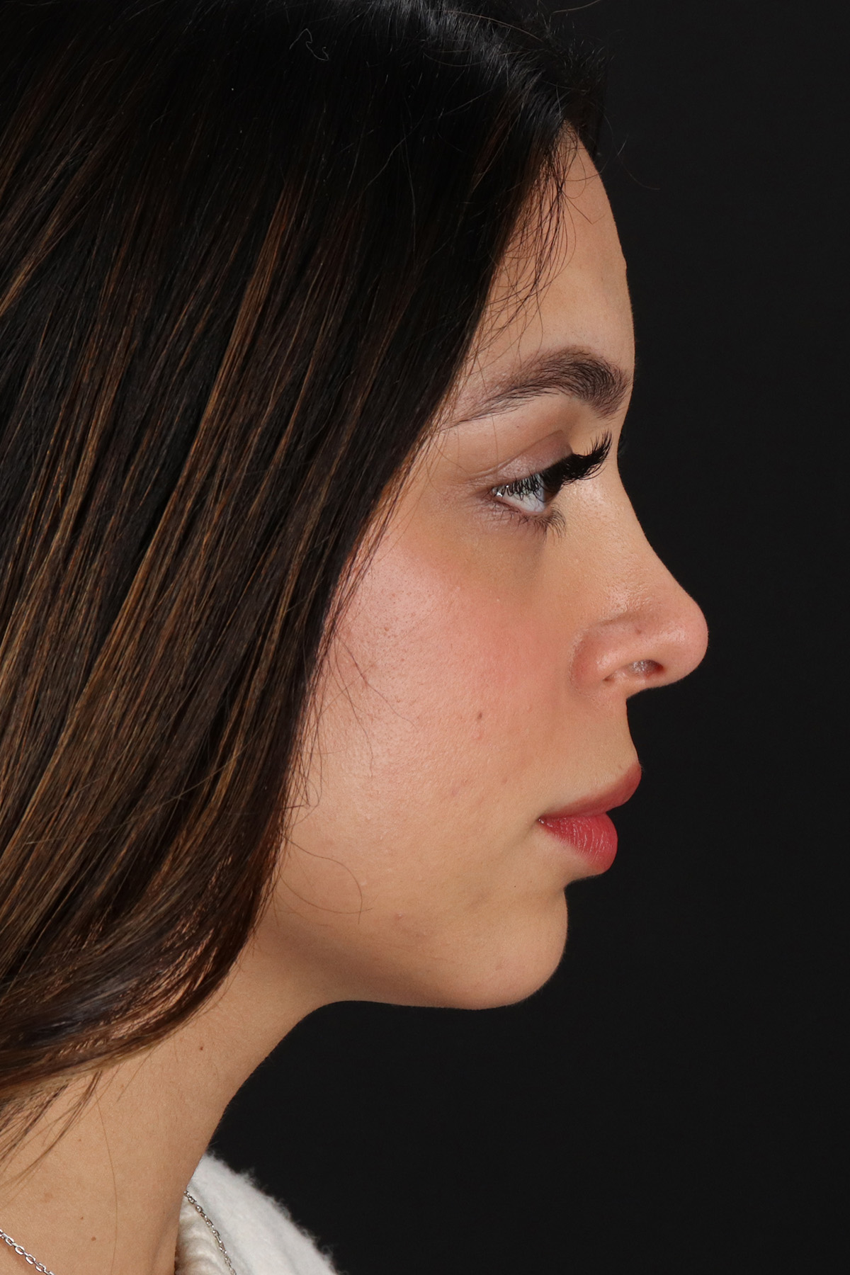 Rhinoplasty Before & After Patient #3269