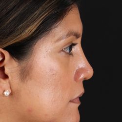 Rhinoplasty Before & After Patient #3181
