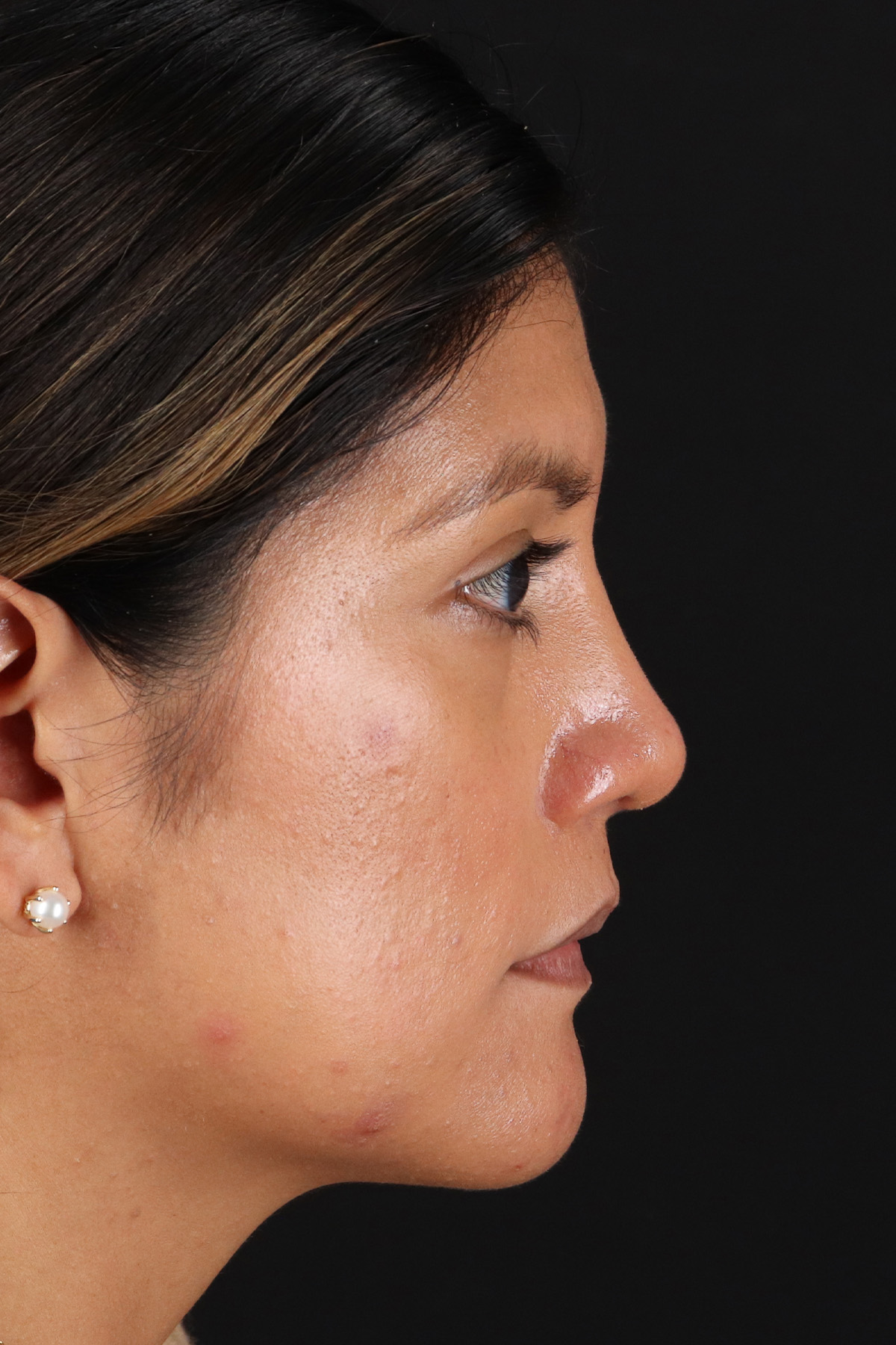 Rhinoplasty Before & After Patient #3181