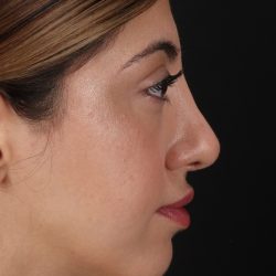 Rhinoplasty Before & After Patient #3214