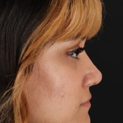 Rhinoplasty Before & After Patient #3038