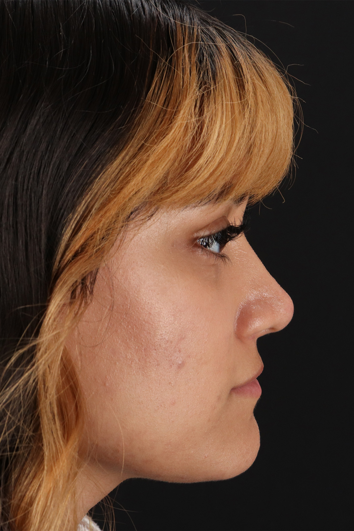 Rhinoplasty Before & After Patient #3038