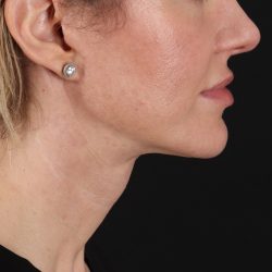 Neck Lift Before & After Patient #2626