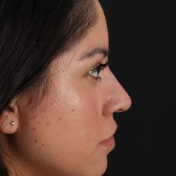 Fillers Before & After Patient #2063