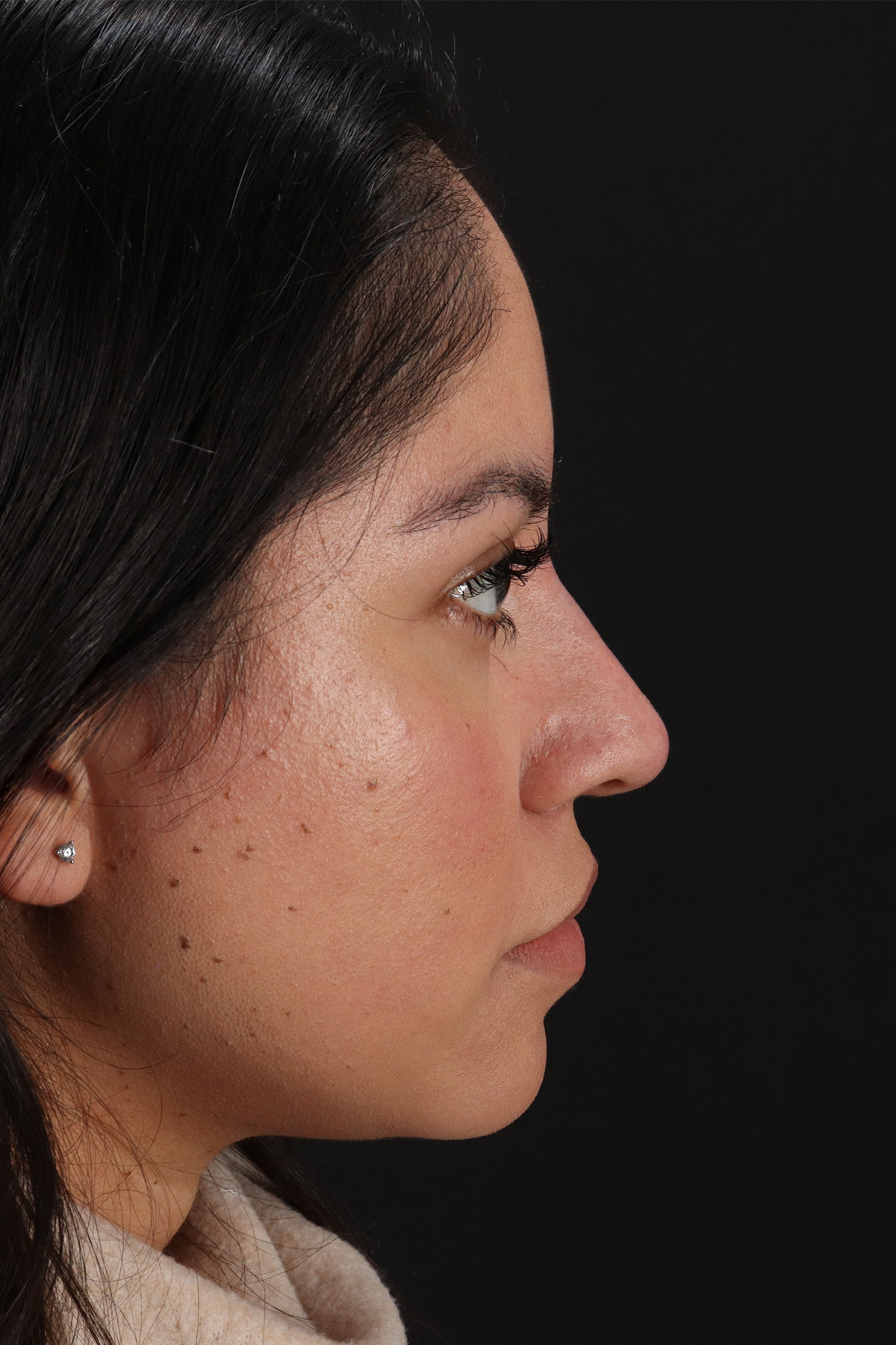Fillers Before & After Patient #2063
