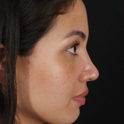 Rhinoplasty Before & After Patient #3236
