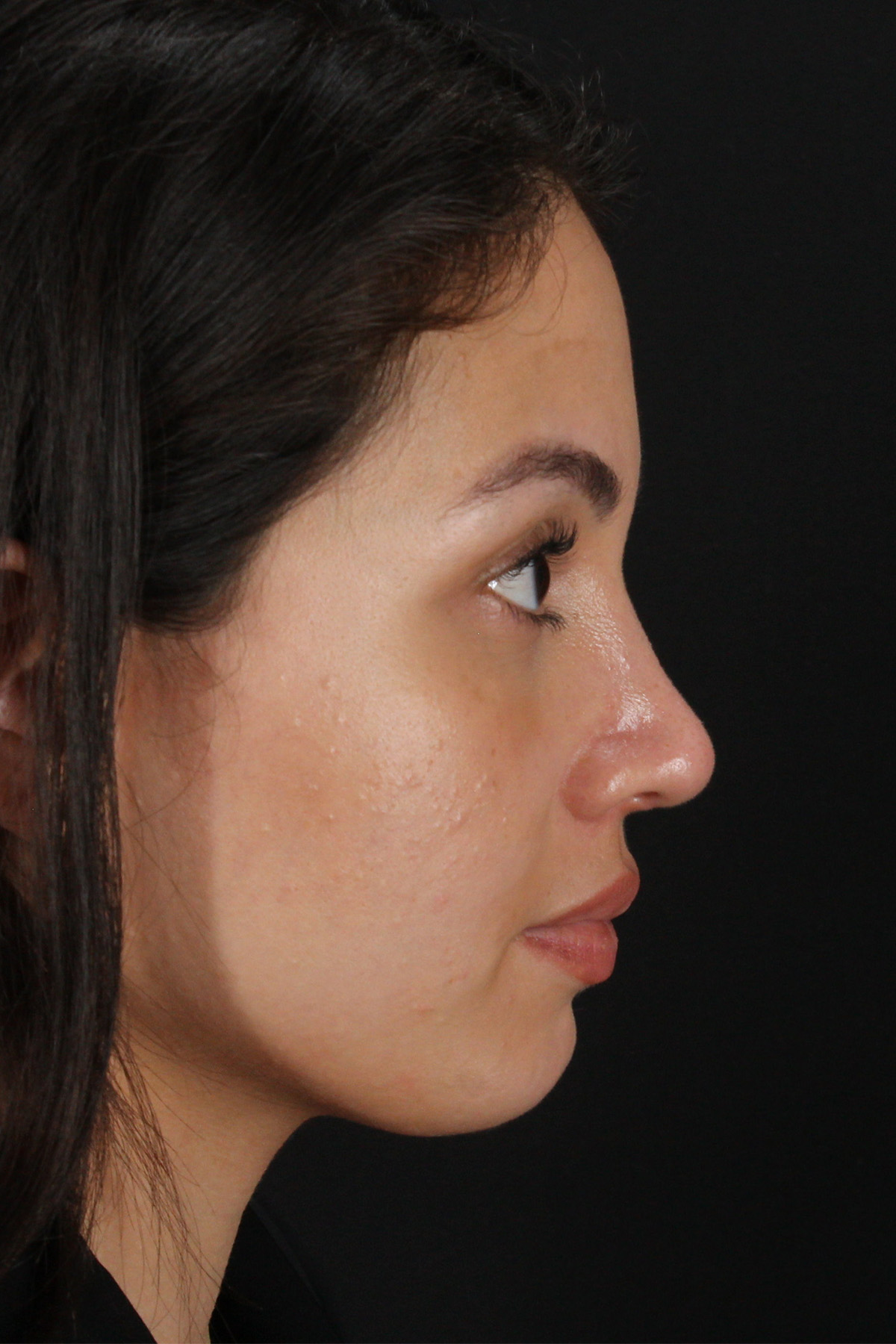 Rhinoplasty Before & After Patient #3236