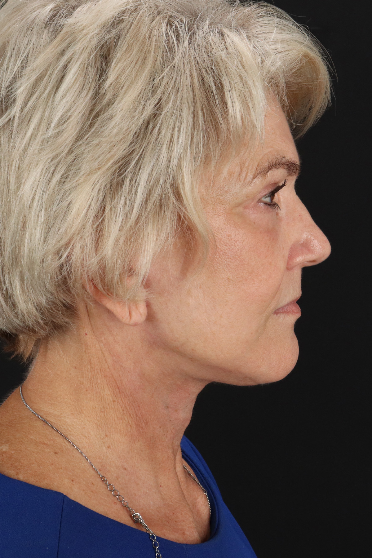 Facelift Before & After Patient #1943