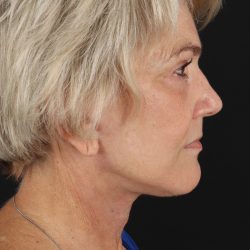 Neck Lift Before & After Patient #2648