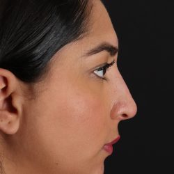 Liquid Rhinoplasty Before & After Patient #2232