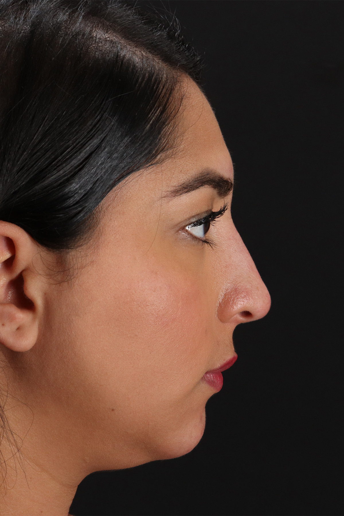Liquid Rhinoplasty Before & After Patient #2232