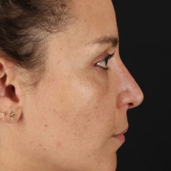 Liquid Rhinoplasty Before & After Patient #2276