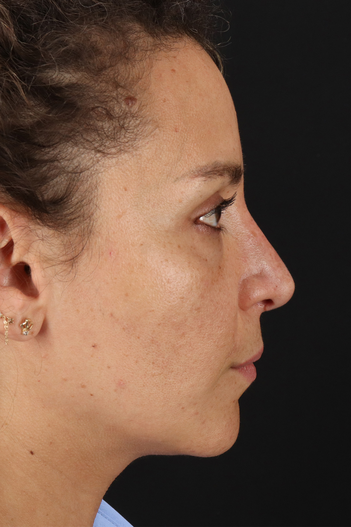 Liquid Rhinoplasty Before & After Patient #2276