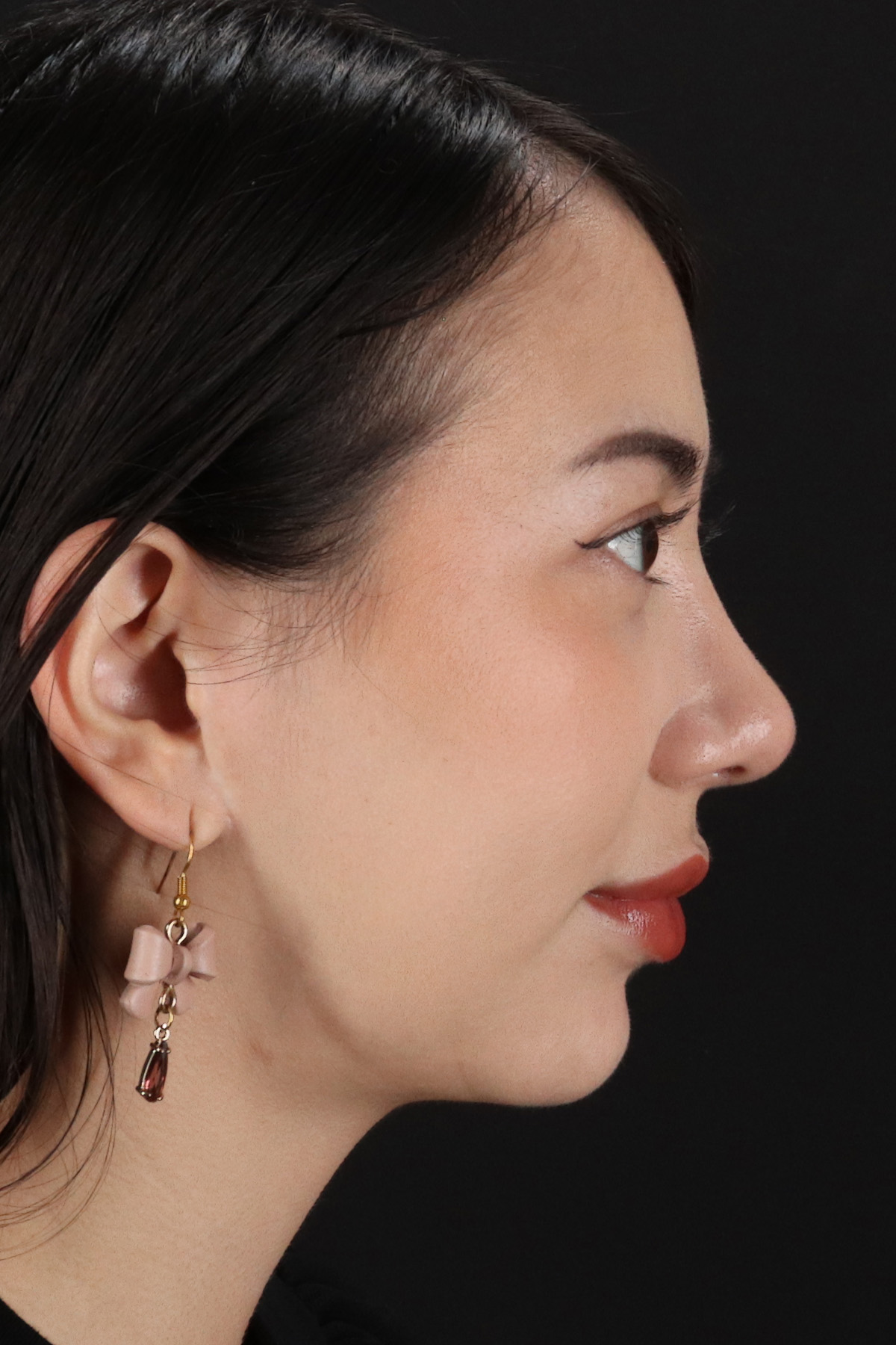 Rhinoplasty Before & After Patient #3159