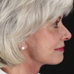 Upper Blepharoplasty Before & After Patient #5377