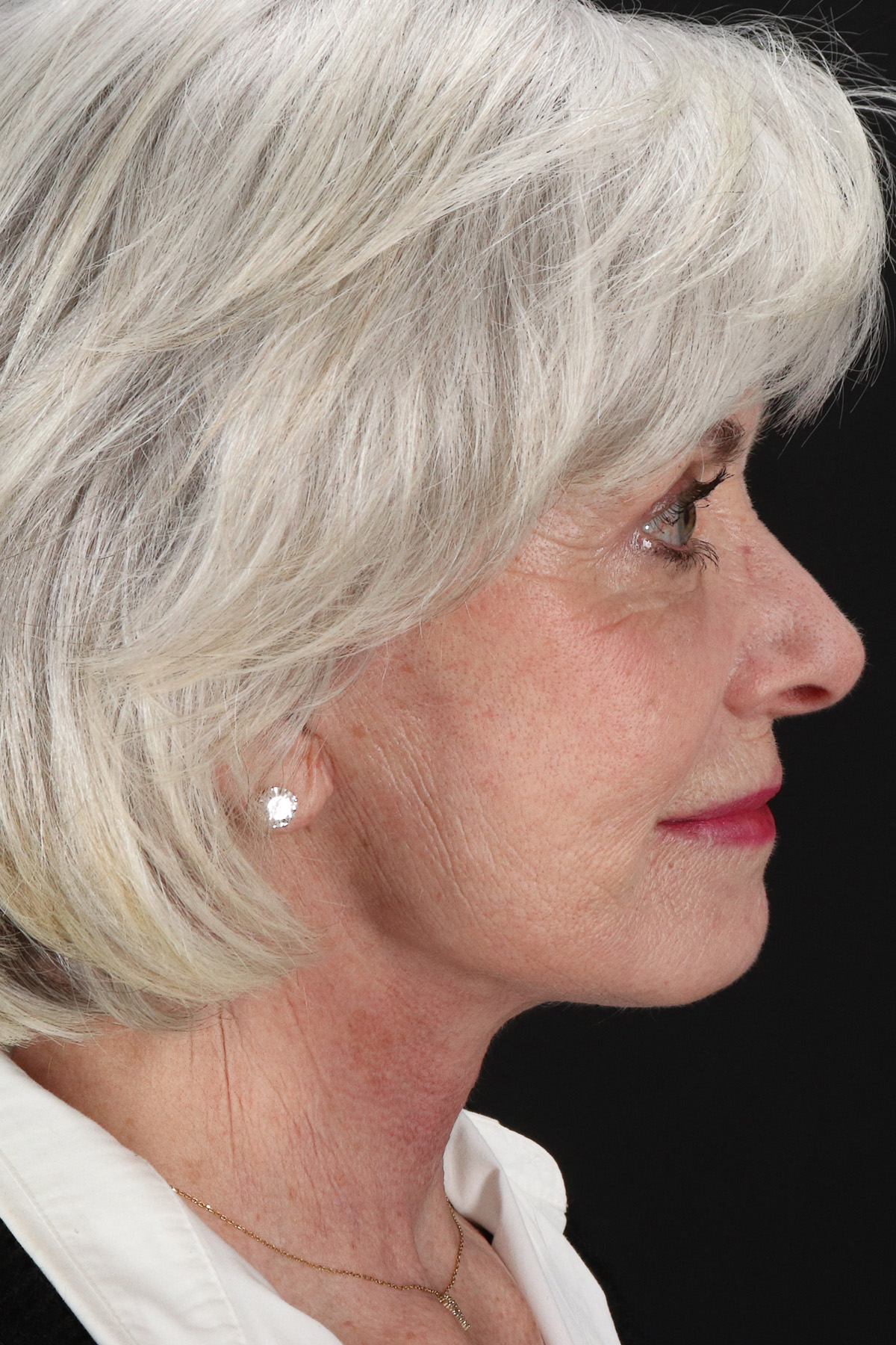 Upper Blepharoplasty Before & After Patient #5377