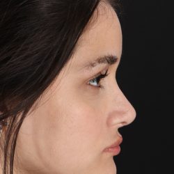 Rhinoplasty Before & After Patient #3258