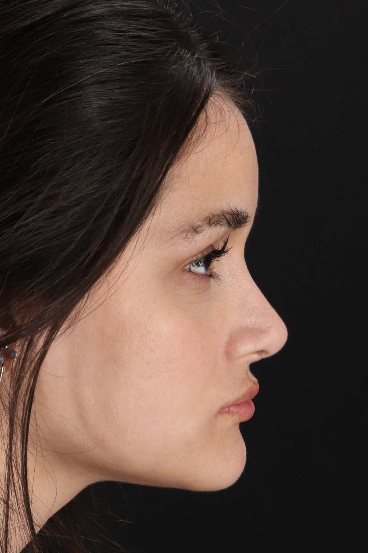 Rhinoplasty Before & After Patient #3258