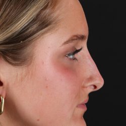 Liquid Rhinoplasty Before & After Patient #2221