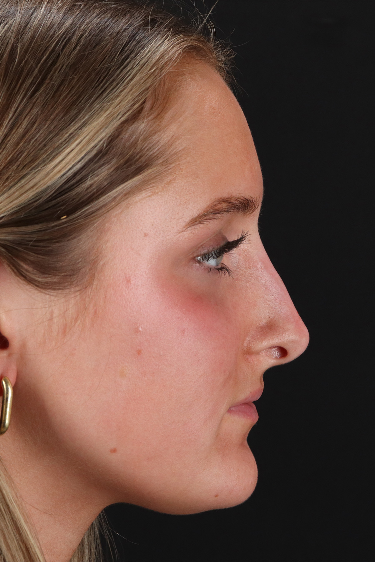 Liquid Rhinoplasty Before & After Patient #2221
