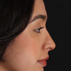Chin Implant Before & After Patient #1637