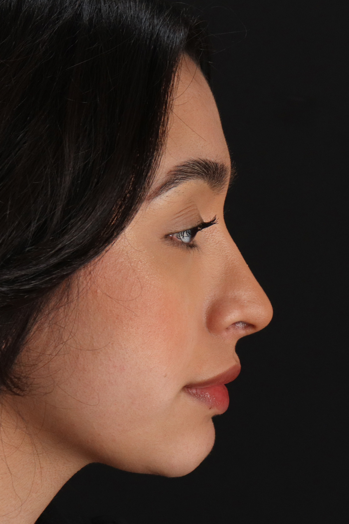 Chin Implant Before & After Patient #1637
