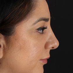 Rhinoplasty Before & After Patient #3115
