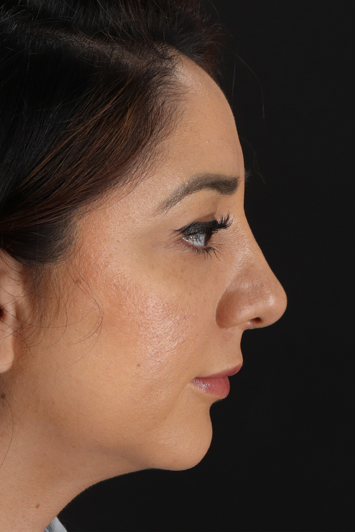 Rhinoplasty Before & After Patient #3115