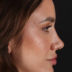 Rhinoplasty Before & After Patient #3137