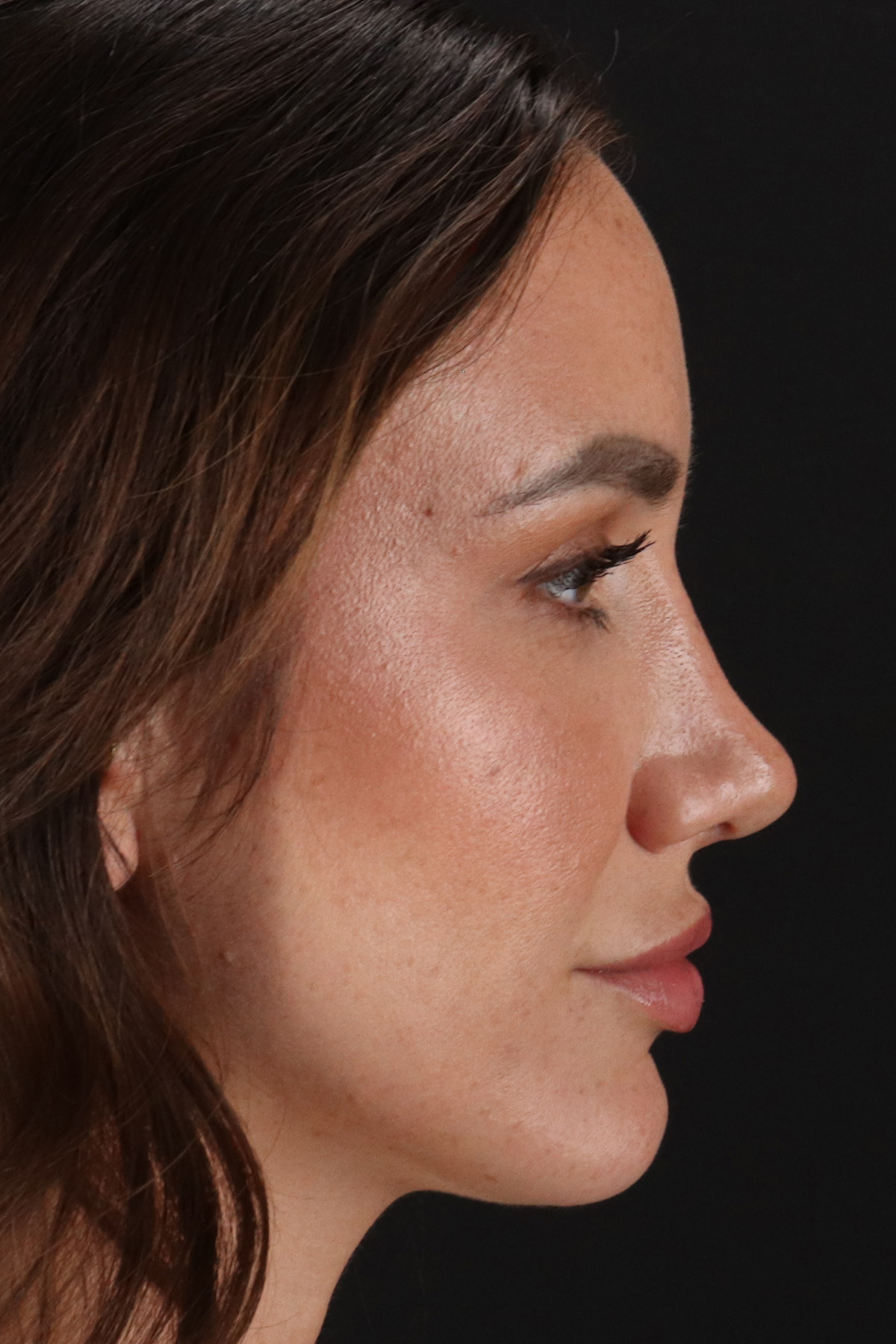 Rhinoplasty Before & After Patient #3137