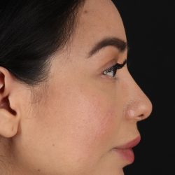 Chin Implant Before & After Patient #1626