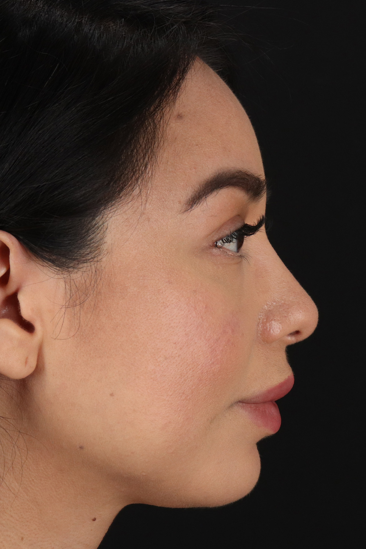 Chin Implant Before & After Patient #1626