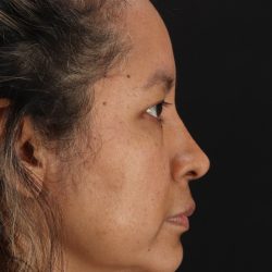 Rhinoplasty Before & After Patient #3225
