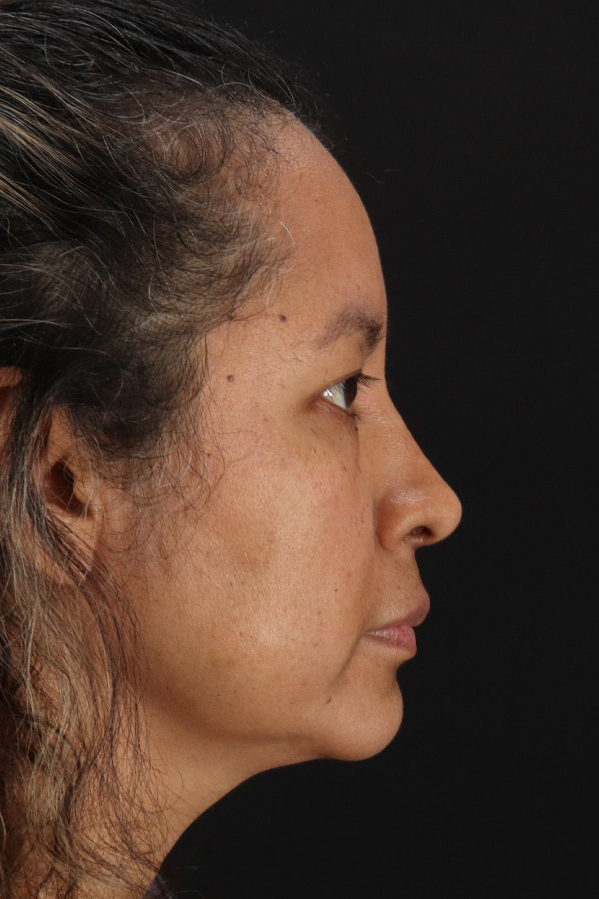 Rhinoplasty Before & After Patient #3225